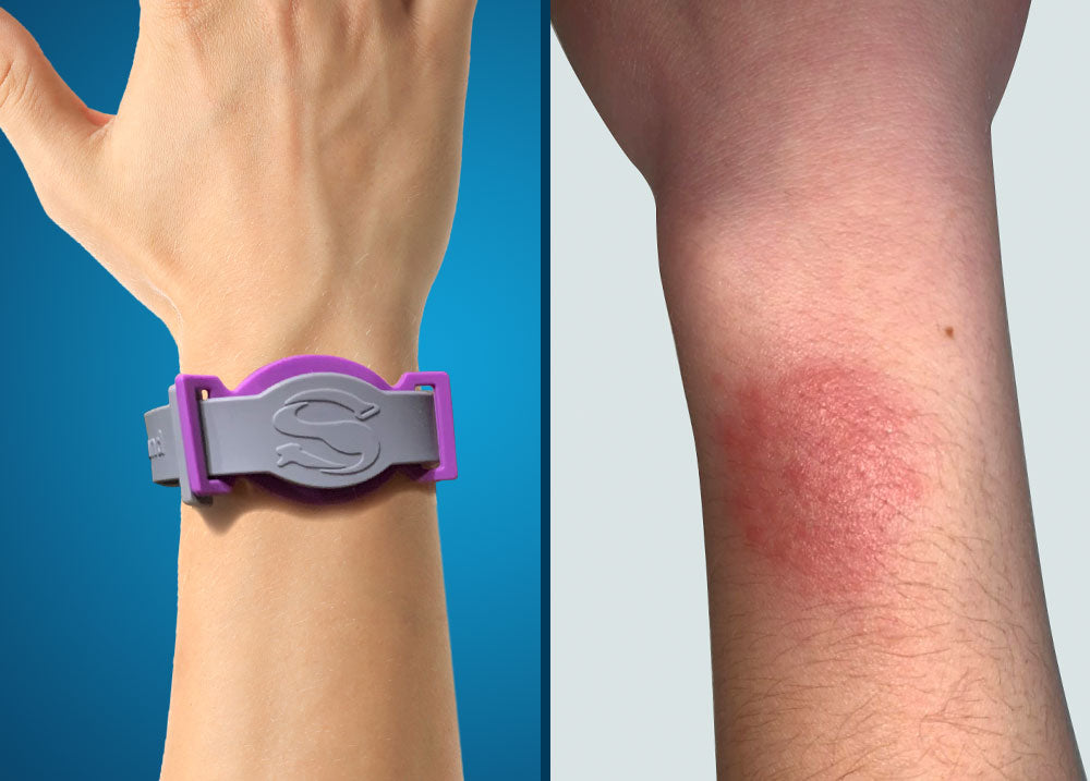 Sensiband on arm and the effects of a metal allergy